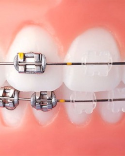 gallery/aparelho-borrachinha-e-porcelana recortada