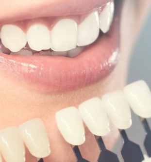 gallery/lente-de-contato-dental recortada